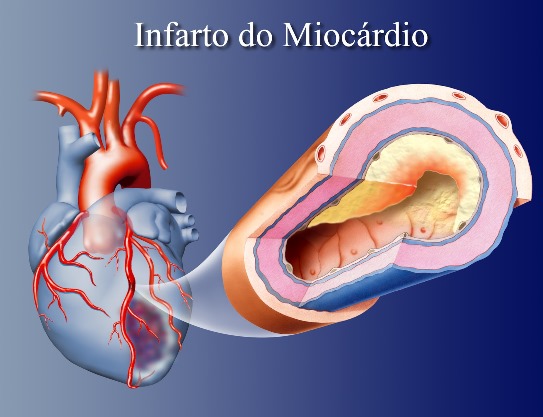 O tabagismo é um dos fatores de risco para o infarto do miocárdio. 